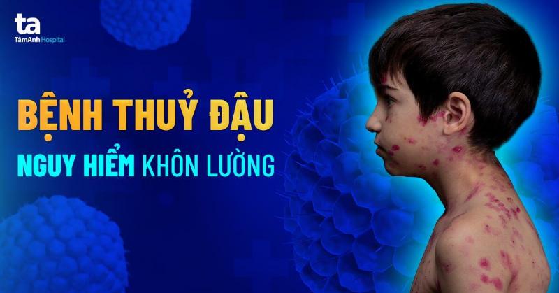 Hình ảnh bệnh đậu lào giai đoạn phát ban ban đầu với các nốt đỏ và bọng nước nhỏ trên da